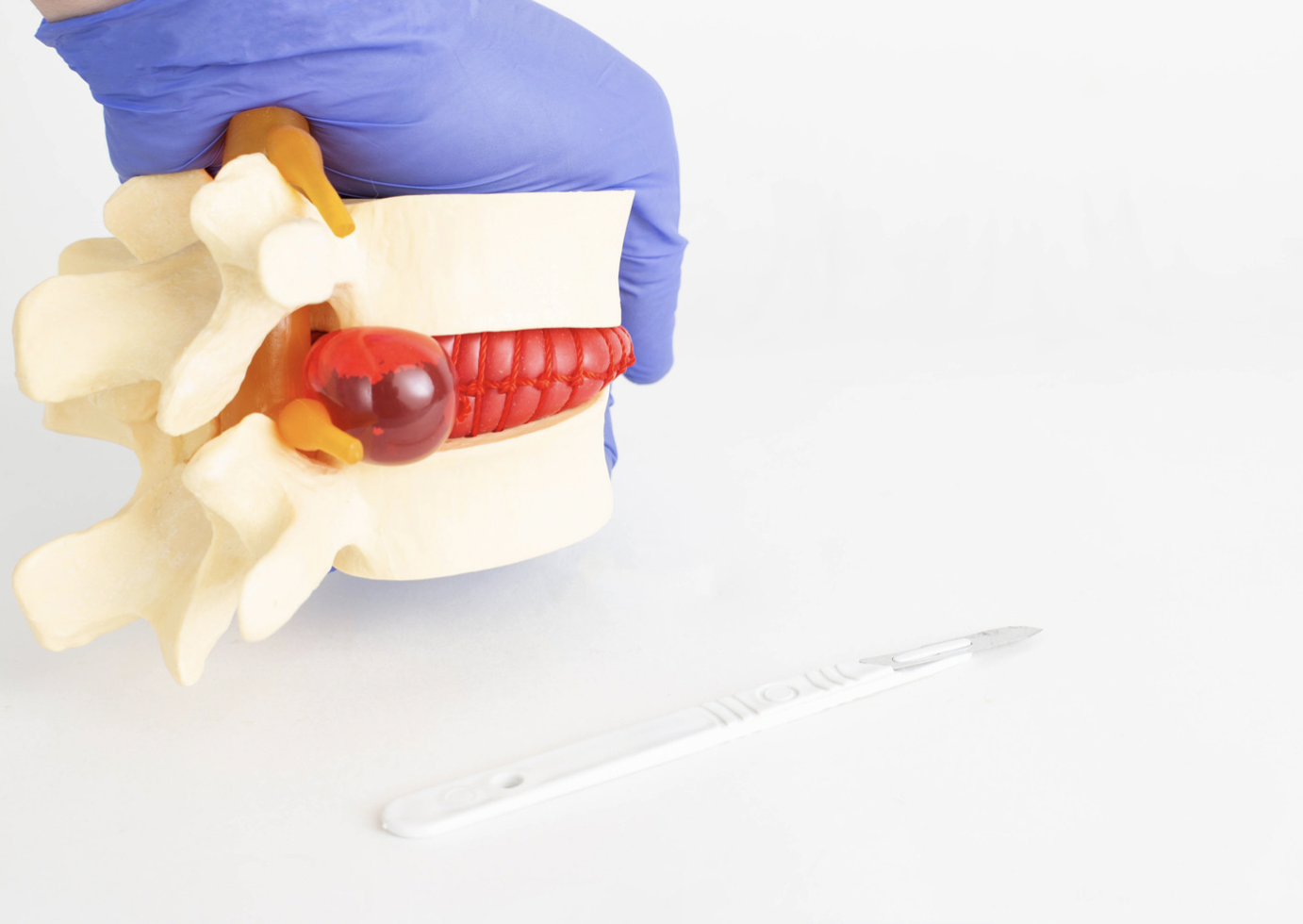Dorsal Root Syndrome